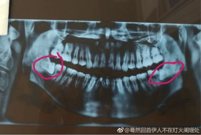 药经验吃智齿冠周炎有用吗_智齿冠周炎吃什么药 经验_智齿冠周炎吃了药怎么越来越疼