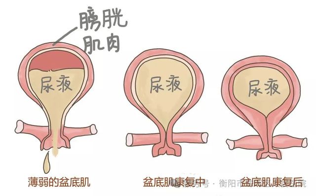 女尿失禁什么原因有三_女性尿失禁原因_女尿失禁什么原因引起的