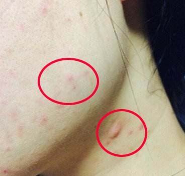 真人体验光子嫩肤!告诉你这上千元花得值不值(图1) 光子嫩肤祛痘价格_光子嫩肤体验分享_果酸焕肤配合光子嫩肤