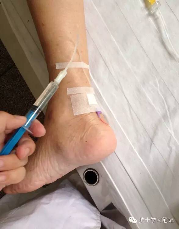 能穿刺的静脉都没成功,这些位置的静脉你可以试试(图2) 静脉穿刺奇葩部位_护士静脉穿刺技巧_静脉输液扎针技巧