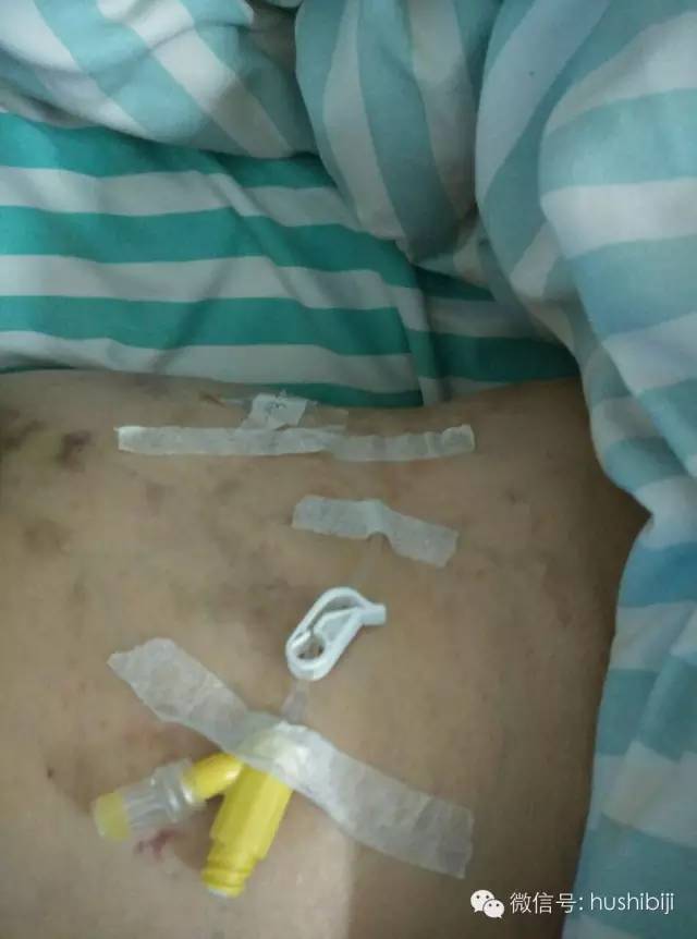 能穿刺的静脉都没成功,这些位置的静脉你可以试试(图11) 静脉输液扎针技巧_静脉穿刺奇葩部位_护士静脉穿刺技巧