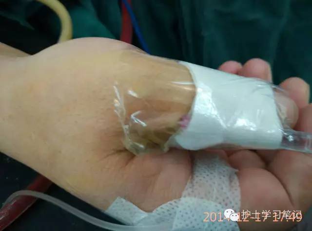 能穿刺的静脉都没成功,这些位置的静脉你可以试试(图12) 静脉穿刺奇葩部位_护士静脉穿刺技巧_静脉输液扎针技巧