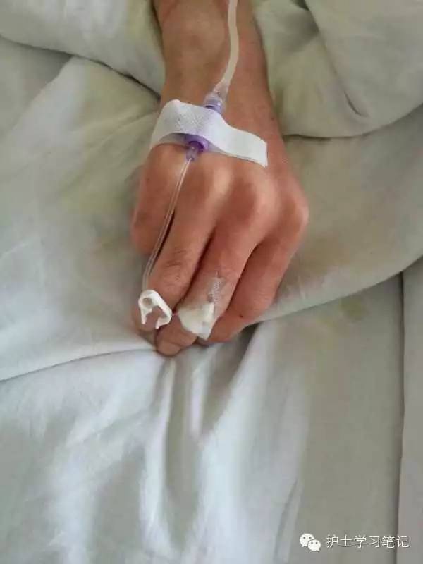 能穿刺的静脉都没成功,这些位置的静脉你可以试试(图13) 护士静脉穿刺技巧_静脉输液扎针技巧_静脉穿刺奇葩部位