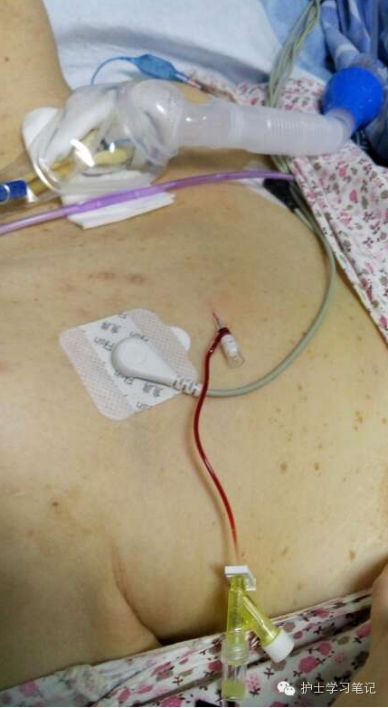 能穿刺的静脉都没成功,这些位置的静脉你可以试试(图15) 护士静脉穿刺技巧_静脉输液扎针技巧_静脉穿刺奇葩部位