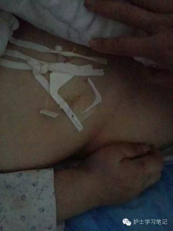 能穿刺的静脉都没成功,这些位置的静脉你可以试试(图16) 护士静脉穿刺技巧_静脉穿刺奇葩部位_静脉输液扎针技巧