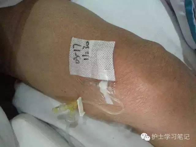 能穿刺的静脉都没成功,这些位置的静脉你可以试试(图17) 静脉穿刺奇葩部位_护士静脉穿刺技巧_静脉输液扎针技巧