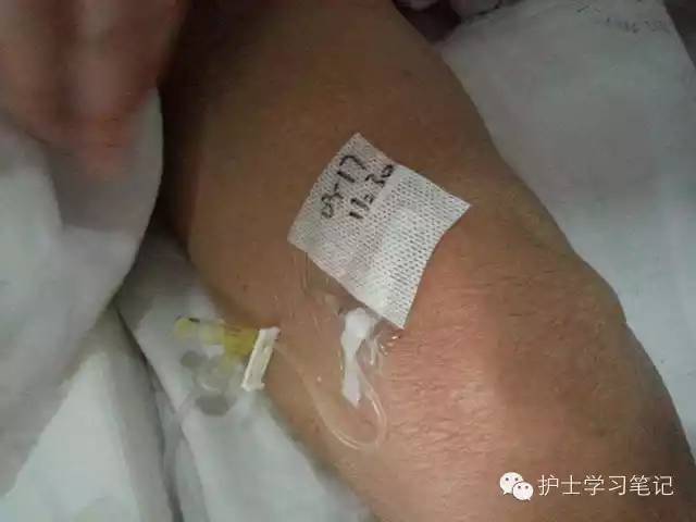 能穿刺的静脉都没成功,这些位置的静脉你可以试试(图18) 静脉输液扎针技巧_护士静脉穿刺技巧_静脉穿刺奇葩部位