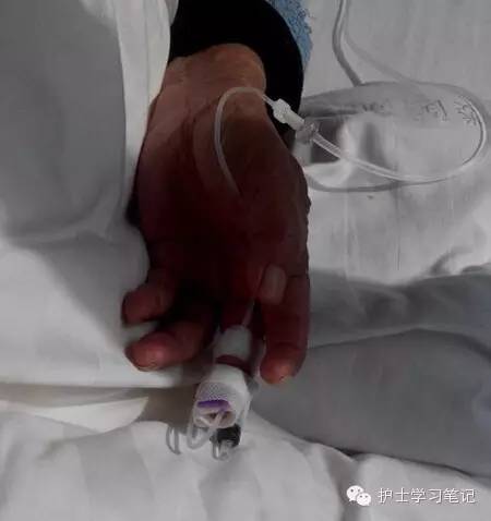 能穿刺的静脉都没成功,这些位置的静脉你可以试试(图3) 静脉穿刺奇葩部位_静脉输液扎针技巧_护士静脉穿刺技巧