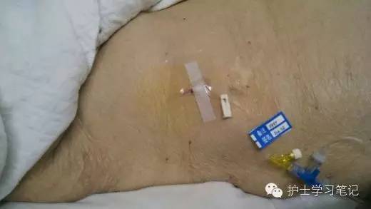 能穿刺的静脉都没成功,这些位置的静脉你可以试试(图22) 静脉穿刺奇葩部位_静脉输液扎针技巧_护士静脉穿刺技巧