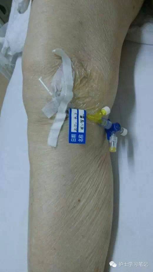 能穿刺的静脉都没成功,这些位置的静脉你可以试试(图23) 护士静脉穿刺技巧_静脉输液扎针技巧_静脉穿刺奇葩部位