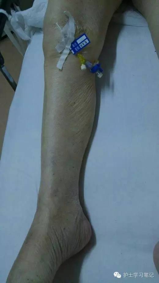 能穿刺的静脉都没成功,这些位置的静脉你可以试试(图24) 静脉输液扎针技巧_静脉穿刺奇葩部位_护士静脉穿刺技巧