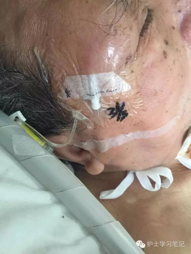 能穿刺的静脉都没成功,这些位置的静脉你可以试试(图25) 静脉输液扎针技巧_护士静脉穿刺技巧_静脉穿刺奇葩部位