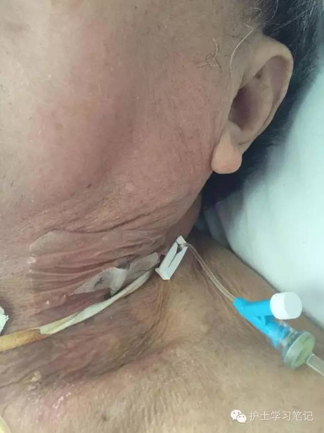 能穿刺的静脉都没成功,这些位置的静脉你可以试试(图26) 护士静脉穿刺技巧_静脉穿刺奇葩部位_静脉输液扎针技巧