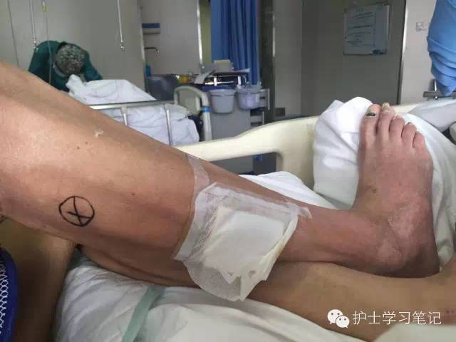 能穿刺的静脉都没成功,这些位置的静脉你可以试试(图27) 静脉输液扎针技巧_静脉穿刺奇葩部位_护士静脉穿刺技巧