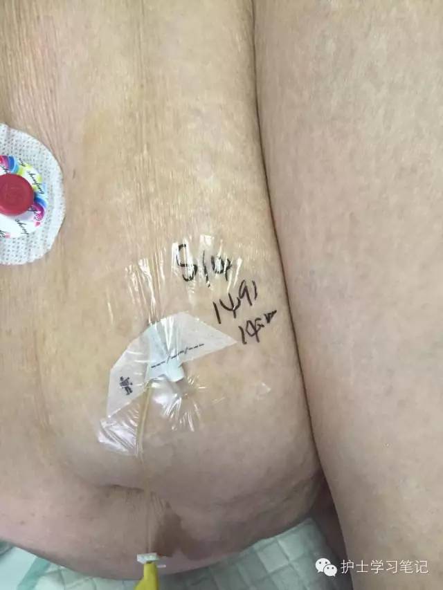 能穿刺的静脉都没成功,这些位置的静脉你可以试试(图28) 护士静脉穿刺技巧_静脉输液扎针技巧_静脉穿刺奇葩部位