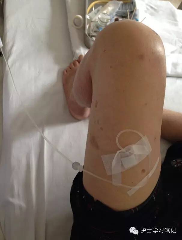 能穿刺的静脉都没成功,这些位置的静脉你可以试试(图4) 护士静脉穿刺技巧_静脉输液扎针技巧_静脉穿刺奇葩部位