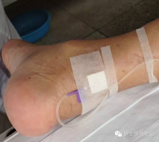 能穿刺的静脉都没成功,这些位置的静脉你可以试试(图5) 静脉穿刺奇葩部位_护士静脉穿刺技巧_静脉输液扎针技巧