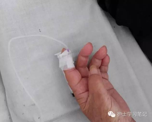 能穿刺的静脉都没成功,这些位置的静脉你可以试试(图6) 静脉输液扎针技巧_护士静脉穿刺技巧_静脉穿刺奇葩部位