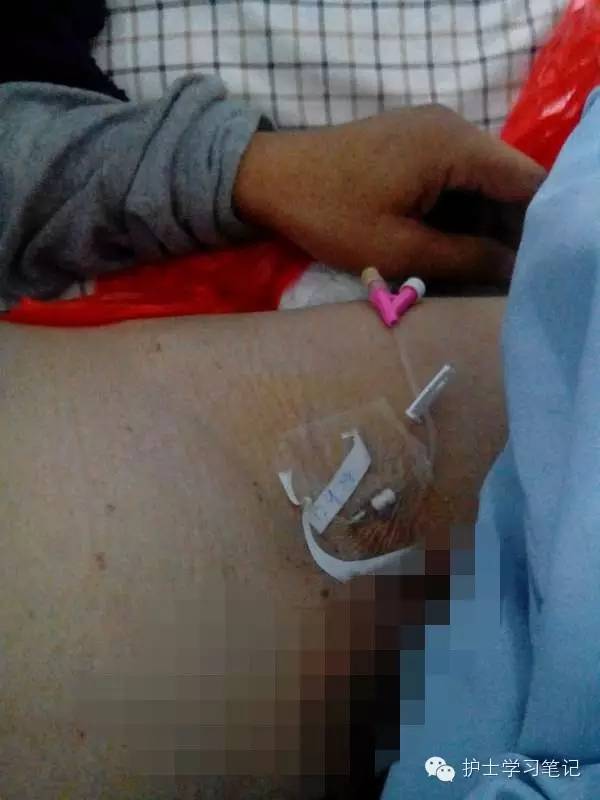能穿刺的静脉都没成功,这些位置的静脉你可以试试(图7) 静脉穿刺奇葩部位_静脉输液扎针技巧_护士静脉穿刺技巧