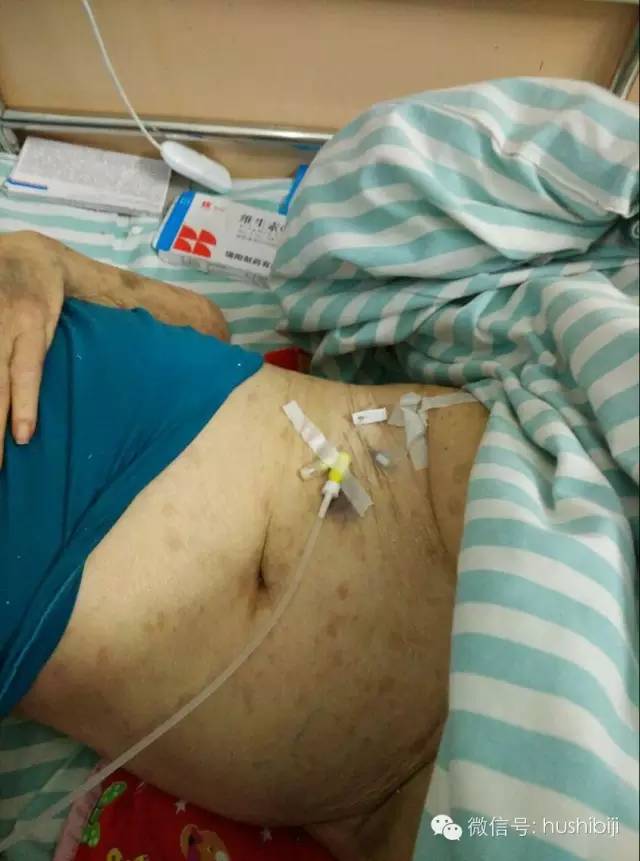 能穿刺的静脉都没成功,这些位置的静脉你可以试试(图9) 静脉穿刺奇葩部位_静脉输液扎针技巧_护士静脉穿刺技巧