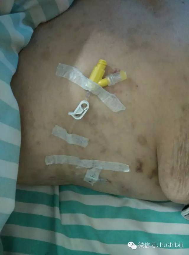 能穿刺的静脉都没成功,这些位置的静脉你可以试试(图10) 护士静脉穿刺技巧_静脉输液扎针技巧_静脉穿刺奇葩部位