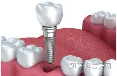 种植牙和装假牙,两种方式的优劣是什么?(图2) 假牙咬合疼痛怎么回事_种植牙优缺点分析_种植牙对比烤瓷牙活动义齿