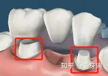 种植牙和装假牙,两种方式的优劣是什么?(图3) 种植牙对比烤瓷牙活动义齿_种植牙优缺点分析_假牙咬合疼痛怎么回事