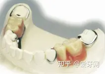 种植牙和装假牙,两种方式的优劣是什么?(图4) 假牙咬合疼痛怎么回事_种植牙对比烤瓷牙活动义齿_种植牙优缺点分析