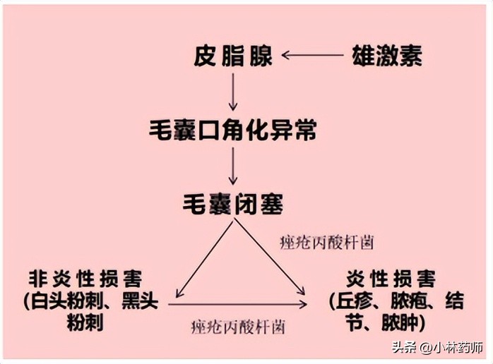 活久见,治好我脸上痘痘的竟然是避孕药!!!(图3) 复方珍珠暗疮片价钱_长痘雄激素过高_避孕药治疗痘痘作用机制
