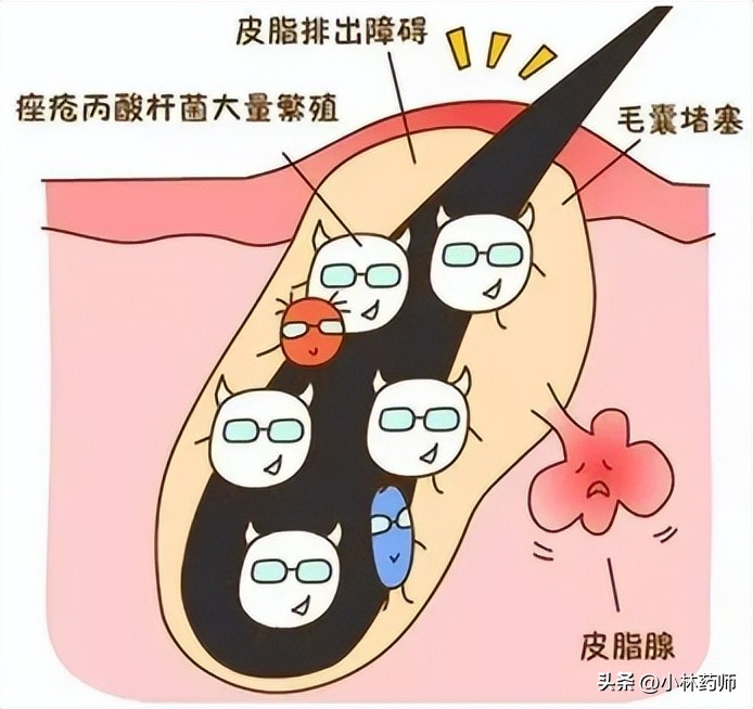 活久见,治好我脸上痘痘的竟然是避孕药!!!(图4) 避孕药治疗痘痘作用机制_长痘雄激素过高_复方珍珠暗疮片价钱