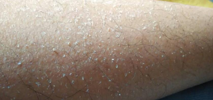 脱衣服时腿上都有很多皮屑脱落？医生提醒：该补维生素了，别大意