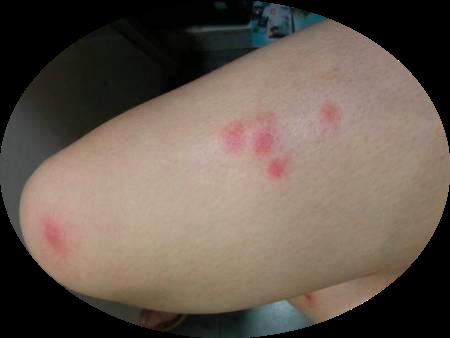 夏天睡凉席，身上发痒过敏是怎么回事？