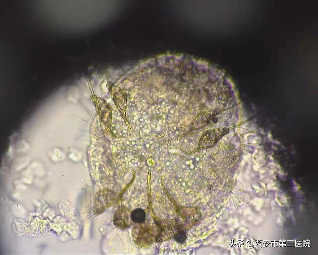 皮肤健康｜易被忽视的集体宿舍杀手--疥疮