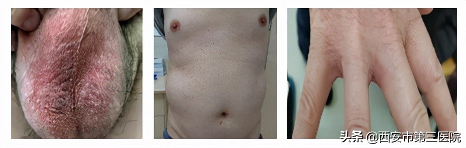 治疗螨虫性皮炎方法_疥螨寄生部位和传播途径_疥疮奇痒症状