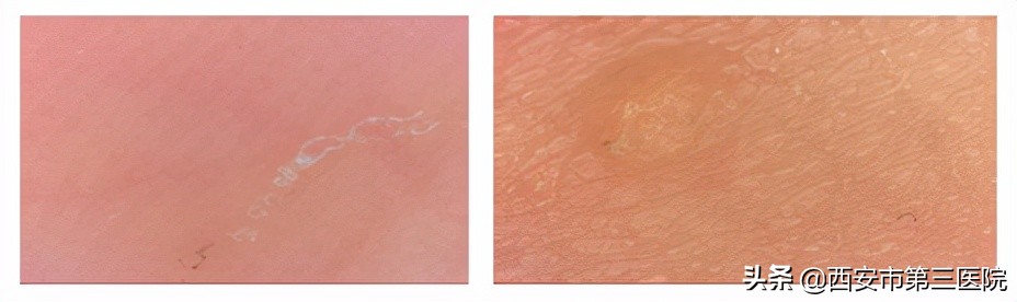 疥螨寄生部位和传播途径_治疗螨虫性皮炎方法_疥疮奇痒症状