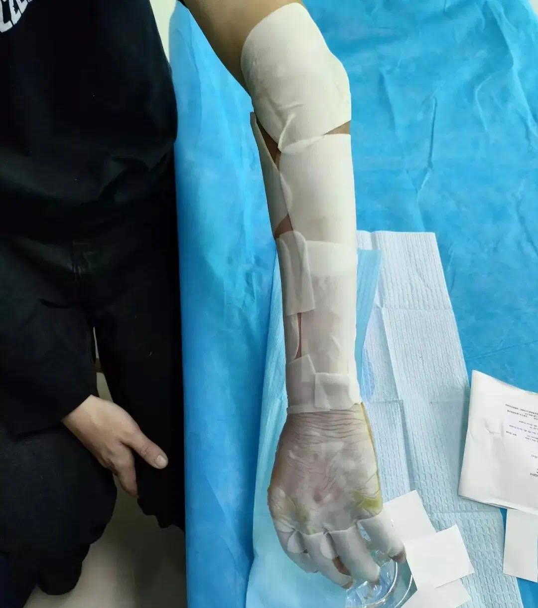 男子手臂不慎滑入开水锅，烫伤布满水泡，医生这样处理不留疤