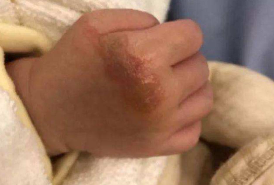 油炸年货做法_孩子油烫伤处理方法_火烫伤起泡怎么处理