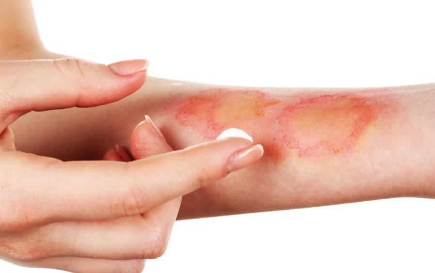 孩子油烫伤处理方法_油炸年货做法_火烫伤起泡怎么处理