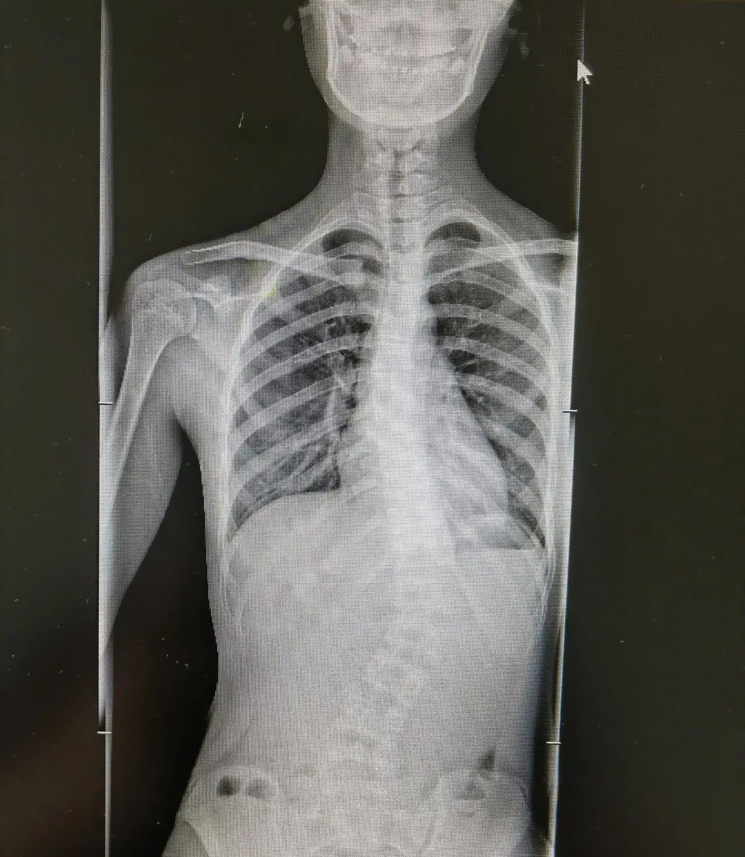 青少年特发性脊柱侧弯 手术治疗 先天性脊柱侧弯_脊柱侧弯吧断棒翻修