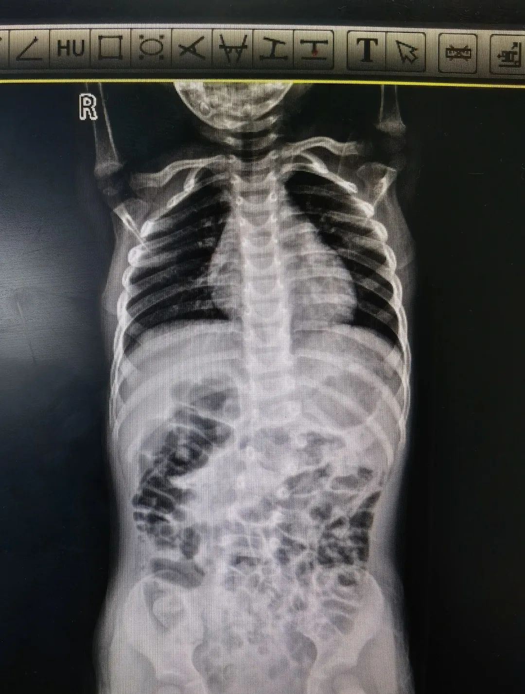 青少年特发性脊柱侧弯 手术治疗 先天性脊柱侧弯_脊柱侧弯吧断棒翻修