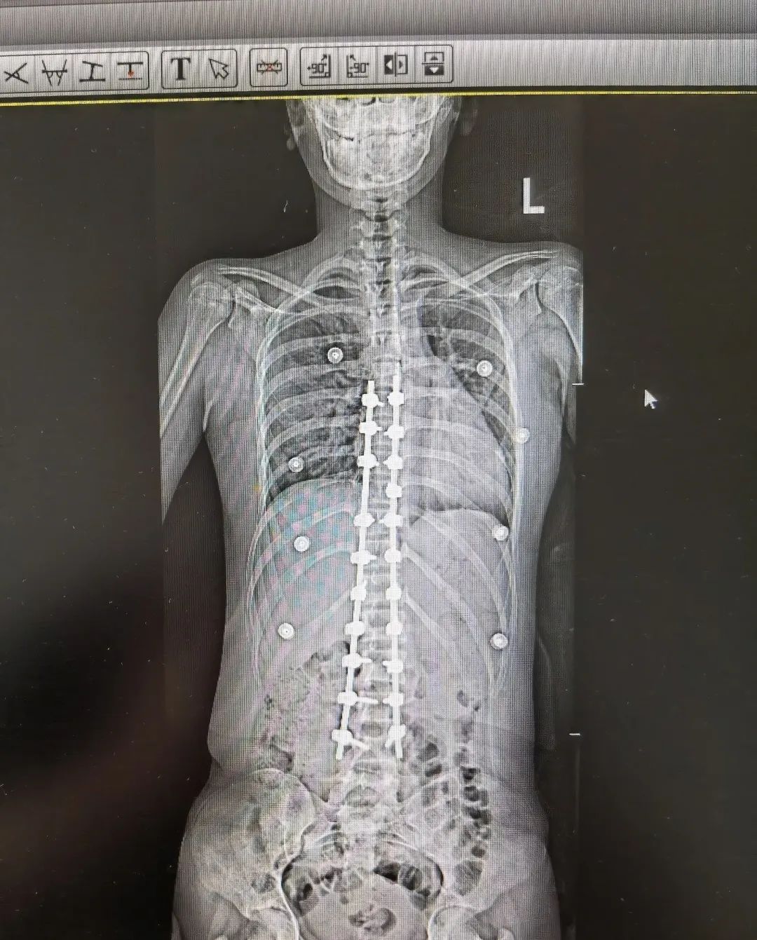 脊柱侧弯吧断棒翻修_青少年特发性脊柱侧弯 手术治疗 先天性脊柱侧弯