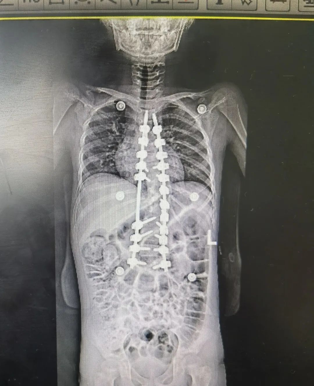 青少年特发性脊柱侧弯 手术治疗 先天性脊柱侧弯_脊柱侧弯吧断棒翻修