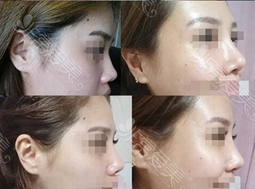 取出硅胶鼻后感受硬硬的？要注意组织粘连选择可溶假体！