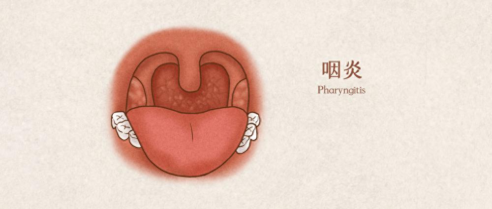 喉咙干痒有异物感，咳不出又咽不下？小心是慢性咽炎在作祟！