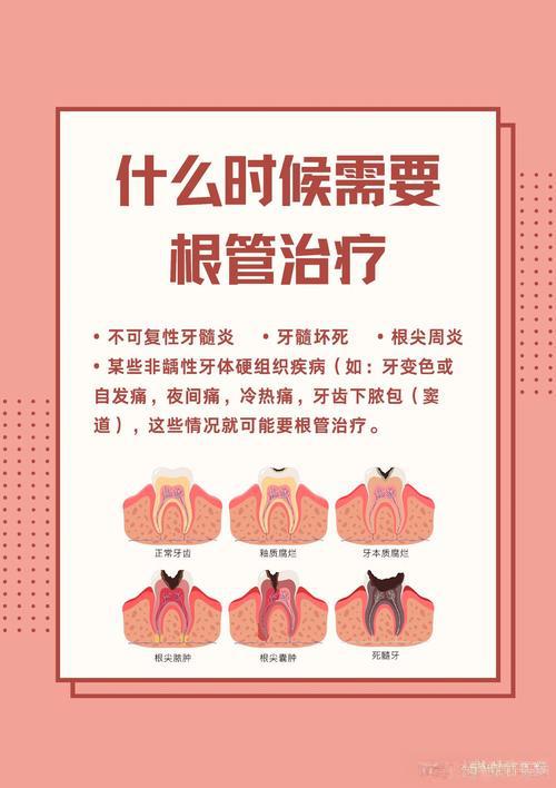 根管治疗多少钱一颗牙